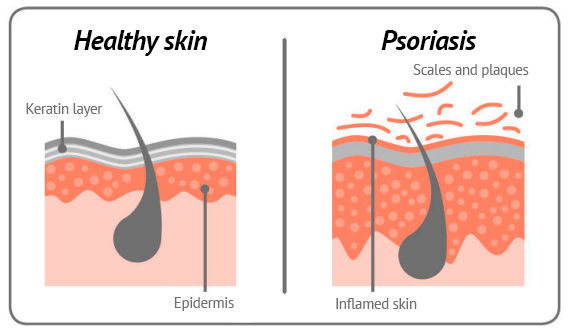 About Psoriasis - Psori.ch